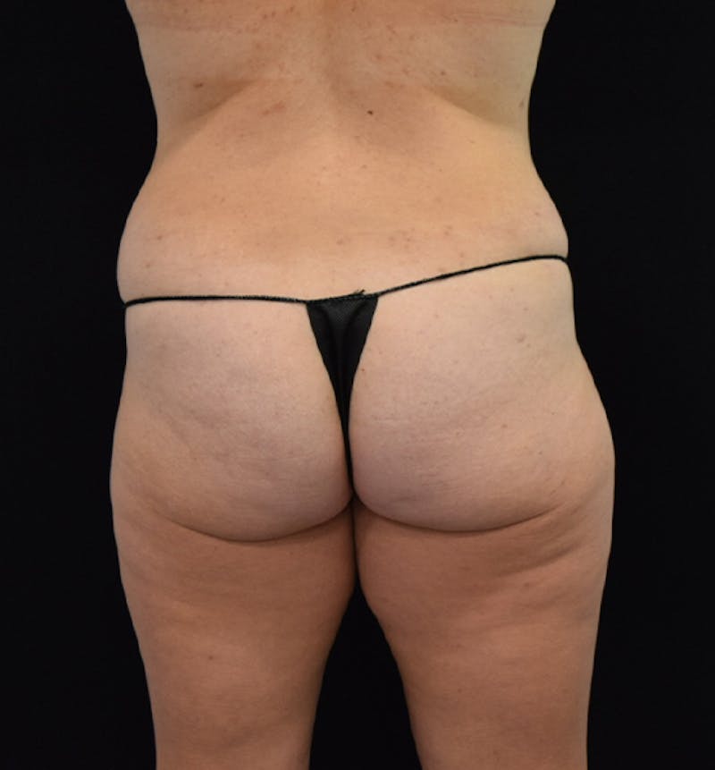 Lower Body Lift Gallery - Patient 102564241 - Image 11