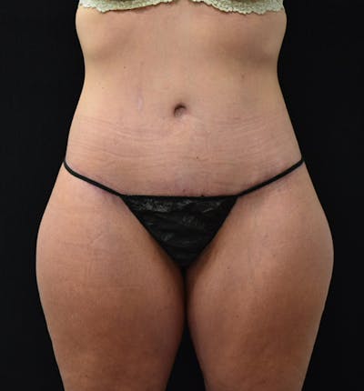 Fat Transfer to Buttock Before & After Gallery - Patient 102564242 - Image 2