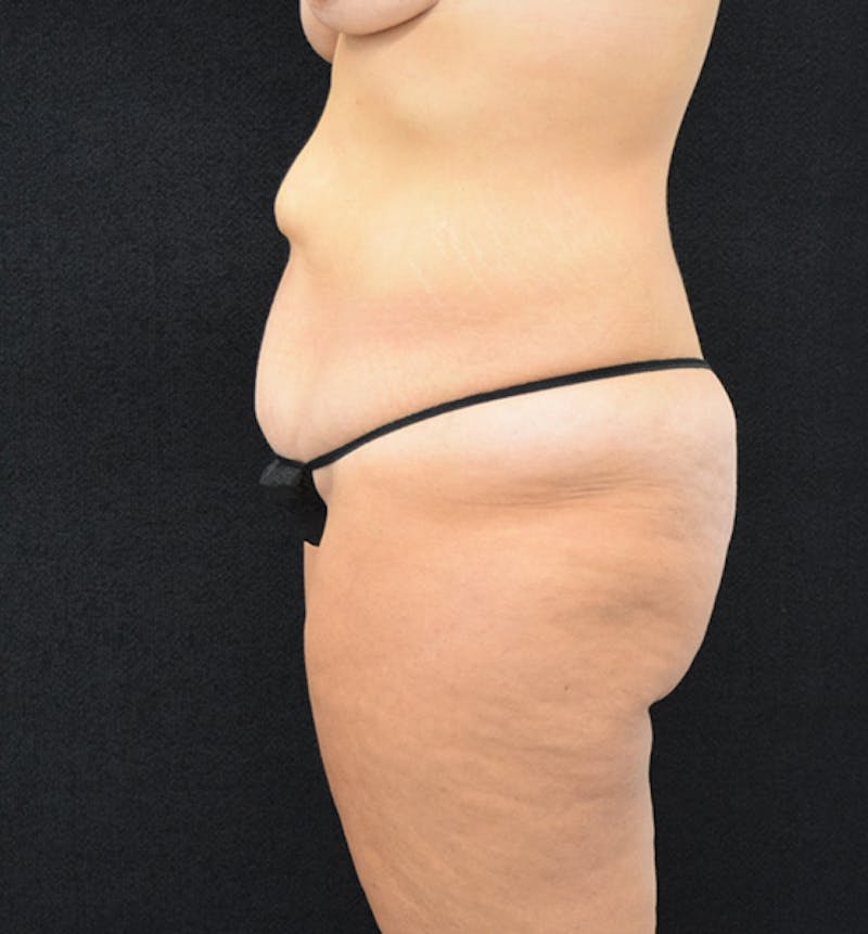 Fat Transfer to Buttock Before & After Gallery - Patient 102564242 - Image 5