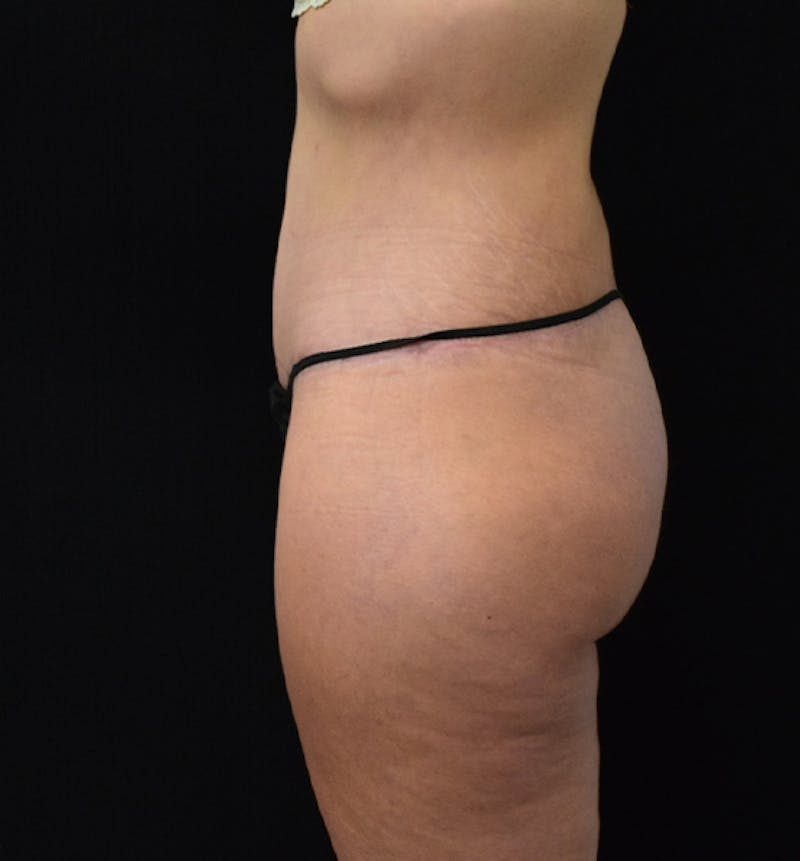Fat Transfer to Buttock Before & After Gallery - Patient 102564242 - Image 6