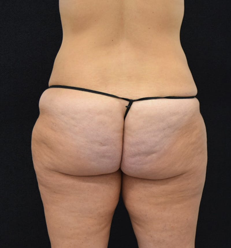 Fat Transfer to Buttock Before & After Gallery - Patient 102564242 - Image 7