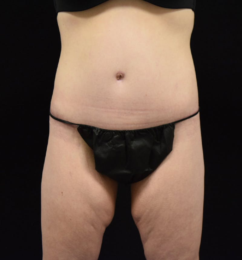 Lower Body Lift Before & After Gallery - Patient 102566064 - Image 2