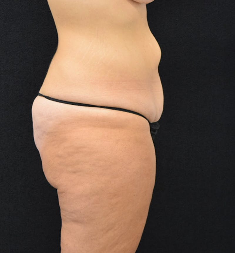Fat Transfer to Buttock Before & After Gallery - Patient 102564242 - Image 9