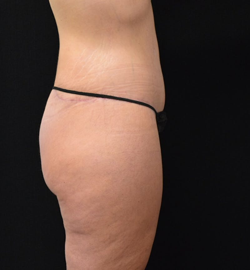 Fat Transfer to Buttock Before & After Gallery - Patient 102564242 - Image 10