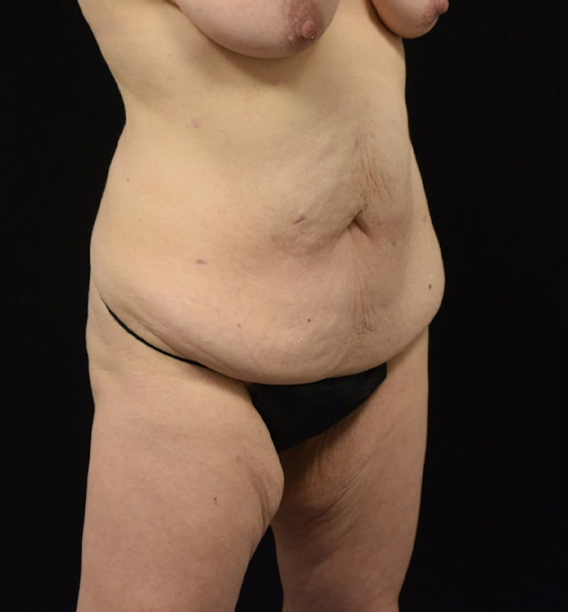 Lower Body Lift Before & After Gallery - Patient 102566064 - Image 3