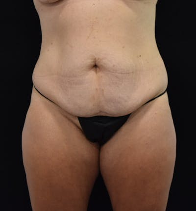 Fat Transfer to Buttock Before & After Gallery - Patient 102566074 - Image 1