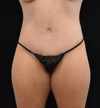 Fat Transfer to Buttock Before & After Gallery - Patient 102566074 - Image 2