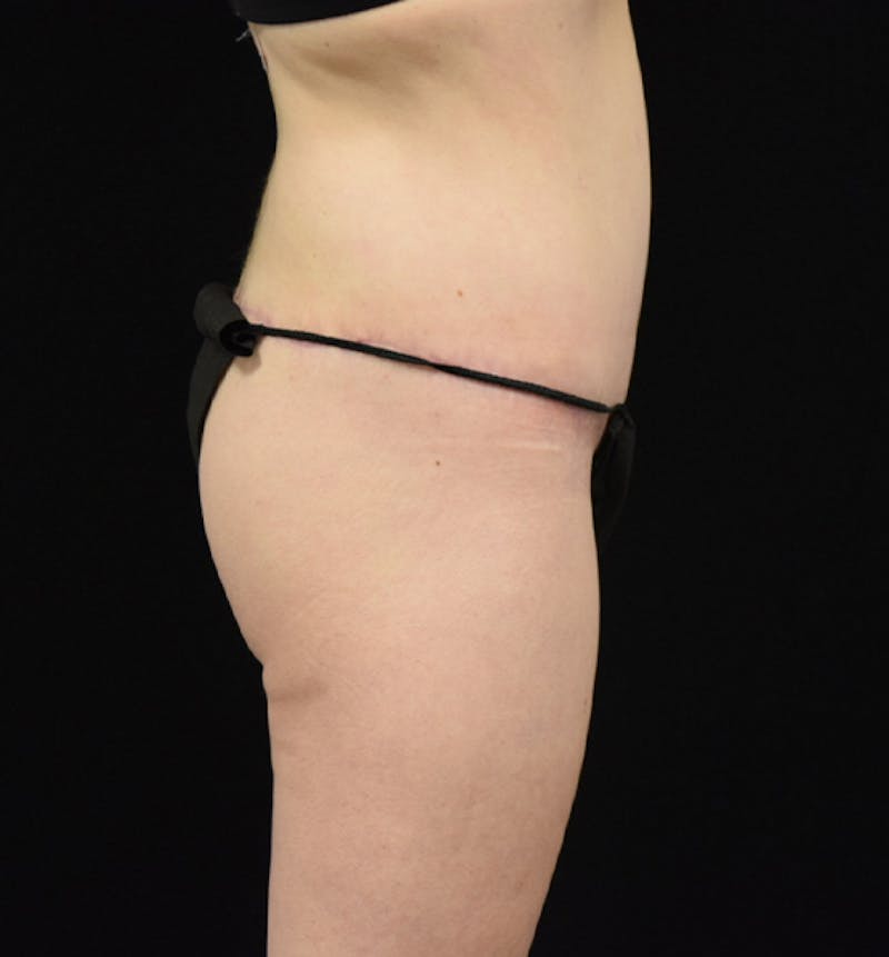 Lower Body Lift Before & After Gallery - Patient 102566064 - Image 6