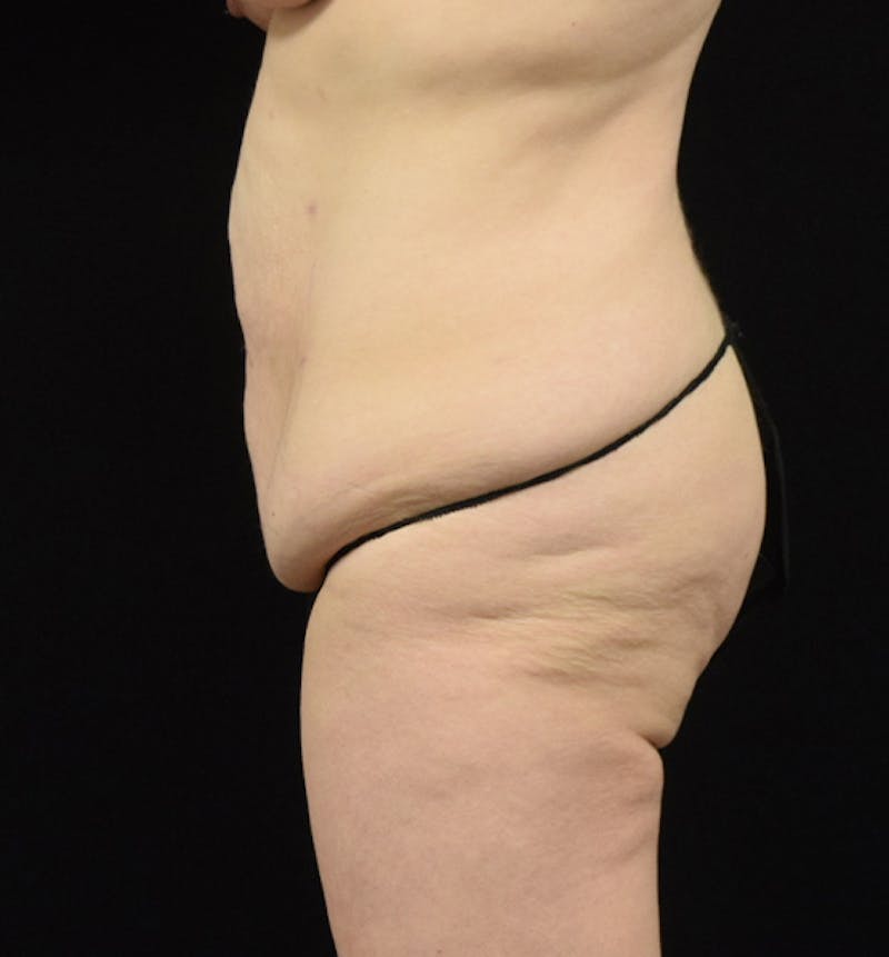 Lower Body Lift Before & After Gallery - Patient 102566064 - Image 7