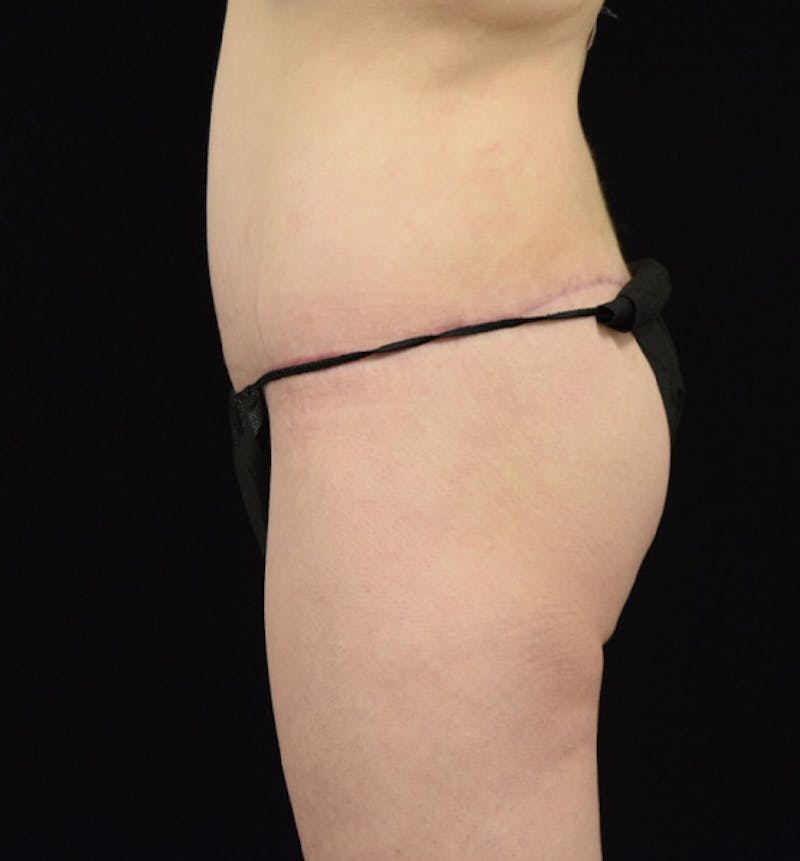 Lower Body Lift Before & After Gallery - Patient 102566064 - Image 8