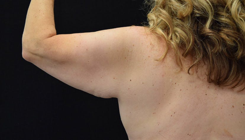 Arm Lift