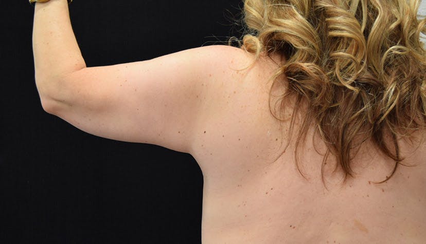 Arm Lift