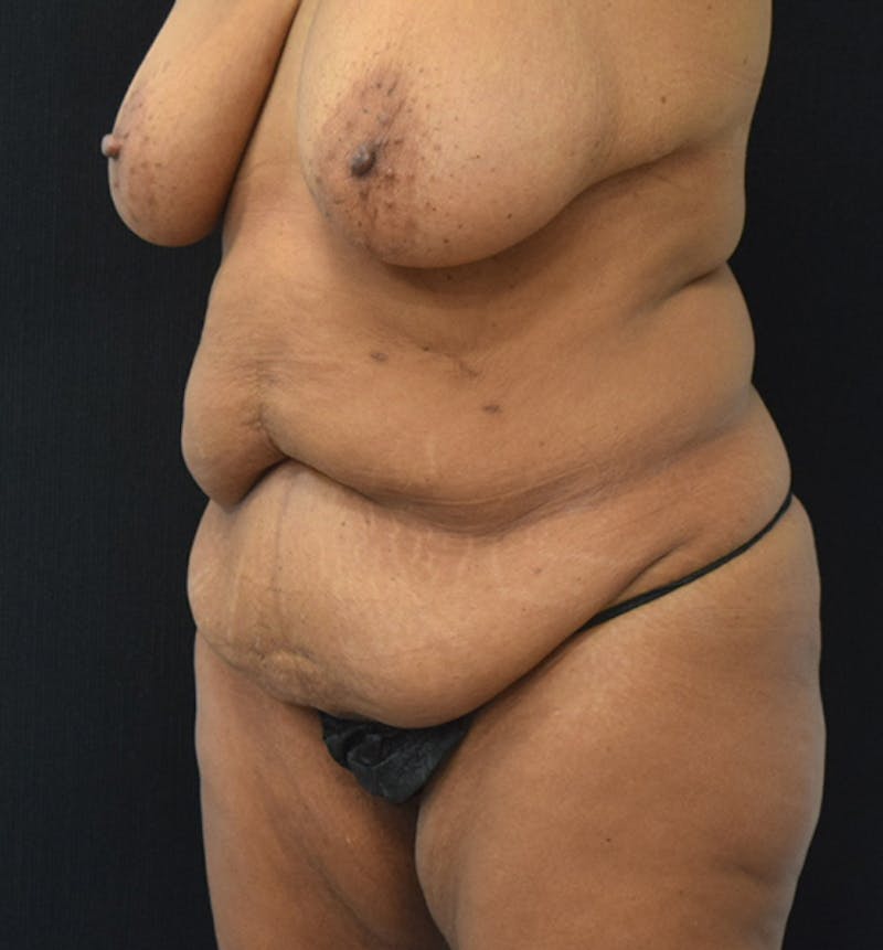 Fat Transfer Gallery - Patient 102566094 - Image 3