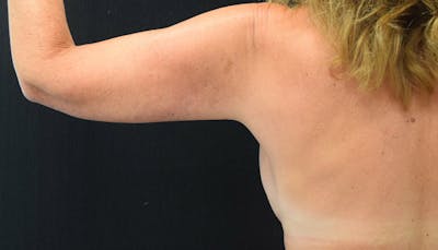 Brachioplasty Before & After Gallery - Patient 102566090 - Image 2