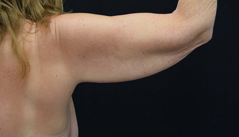 Brachioplasty Before & After Gallery - Patient 102566090 - Image 3