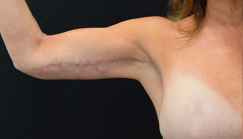 Brachioplasty Before & After Gallery - Patient 102566090 - Image 6