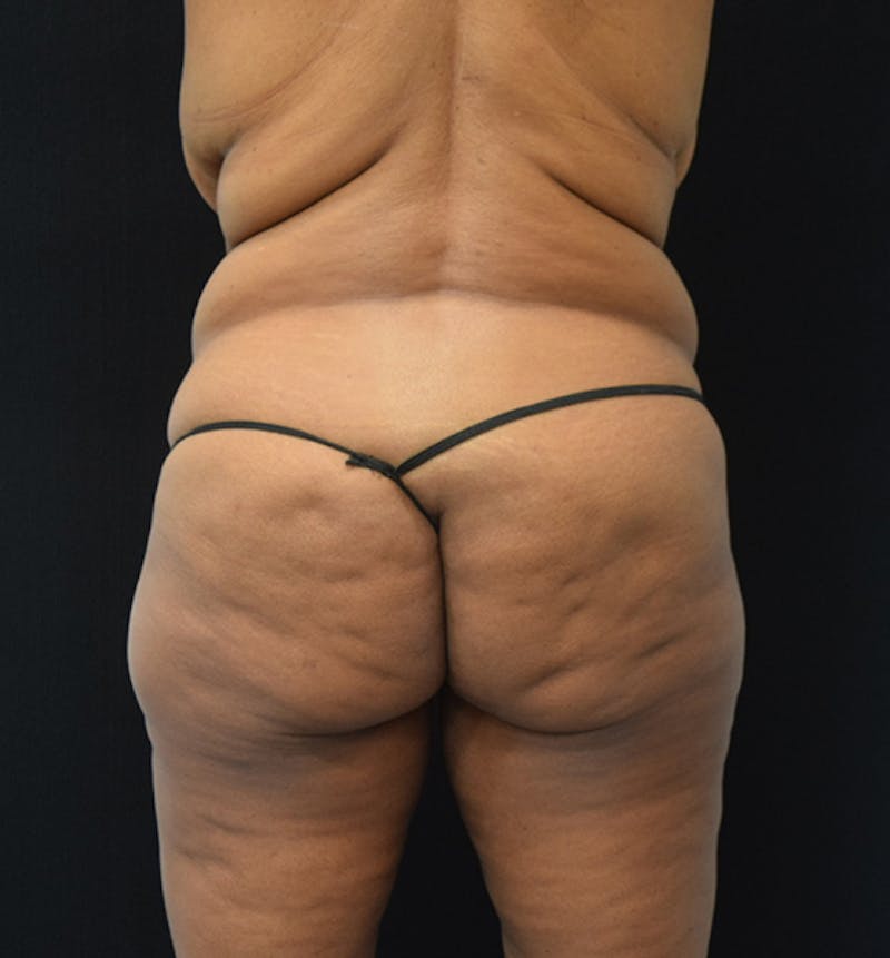 Fat Transfer to Buttock Before & After Gallery - Patient 102566094 - Image 7