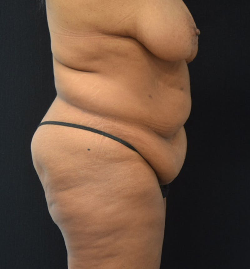 Fat Transfer Gallery - Patient 102566094 - Image 9