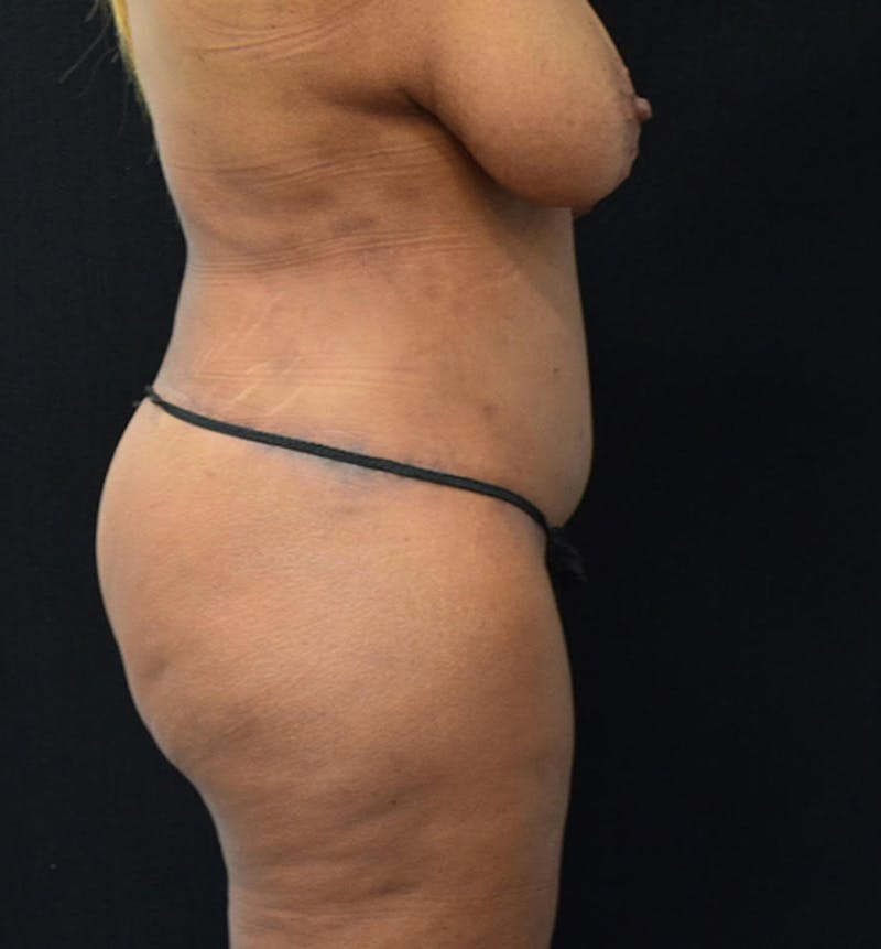Fat Transfer Before & After Gallery - Patient 102566094 - Image 10