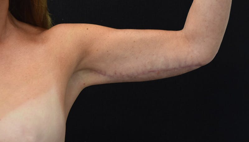 Brachioplasty Before & After Gallery - Patient 102566090 - Image 8