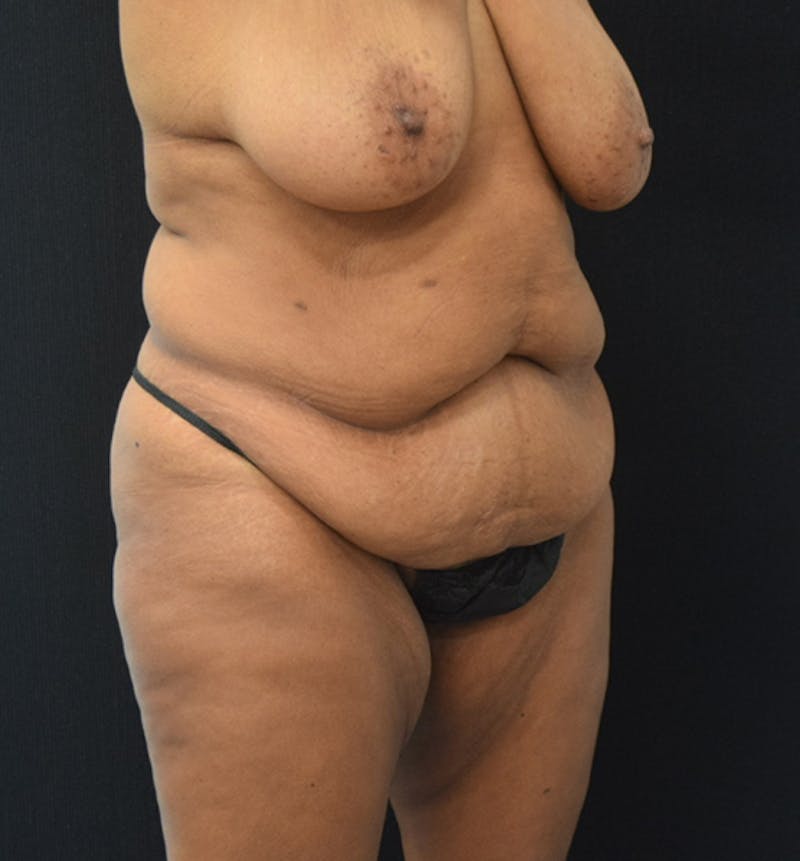 Fat Transfer Gallery - Patient 102566094 - Image 11