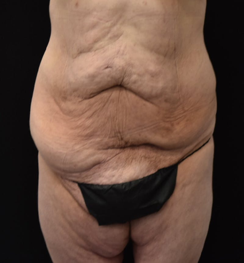 Fat Transfer to Buttock Before & After Gallery - Patient 102566250 - Image 1