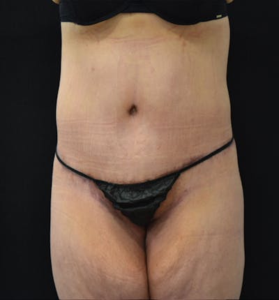 Fat Transfer to Buttock Before & After Gallery - Patient 102566250 - Image 2