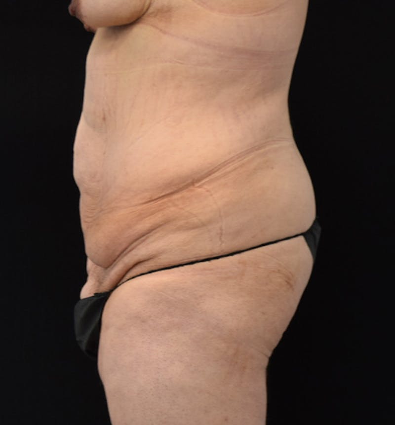 Fat Transfer Before & After Gallery - Patient 102566250 - Image 5
