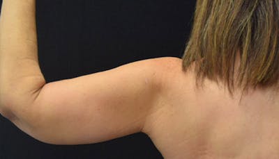 Brachioplasty Before & After Gallery - Patient 102566255 - Image 2