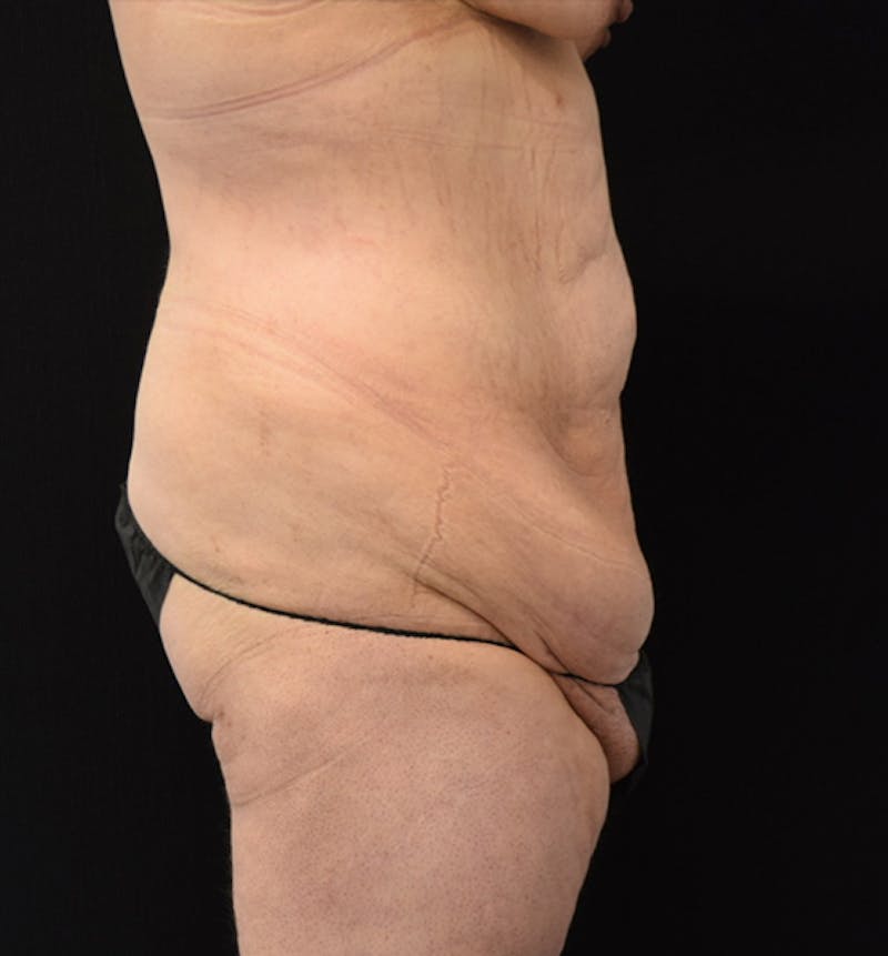 Fat Transfer to Buttock Before & After Gallery - Patient 102566250 - Image 9