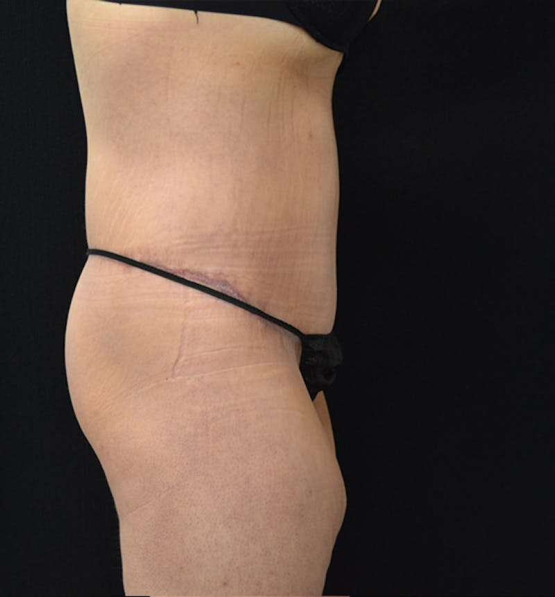 Fat Transfer Before & After Gallery - Patient 102566250 - Image 10