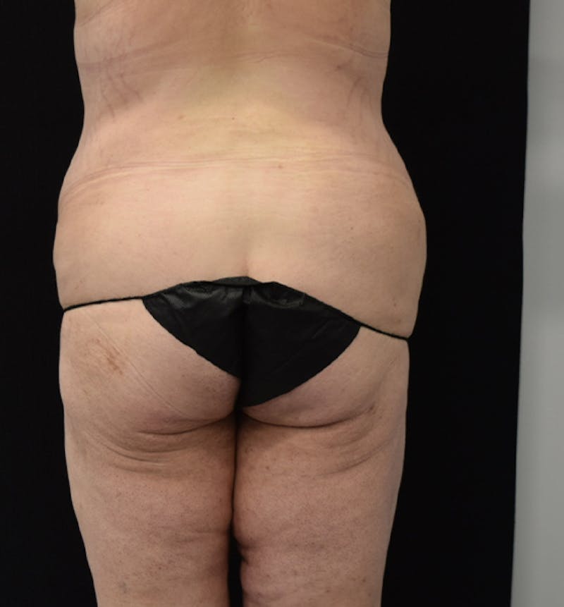 Fat Transfer to Buttock Before & After Gallery - Patient 102566250 - Image 11
