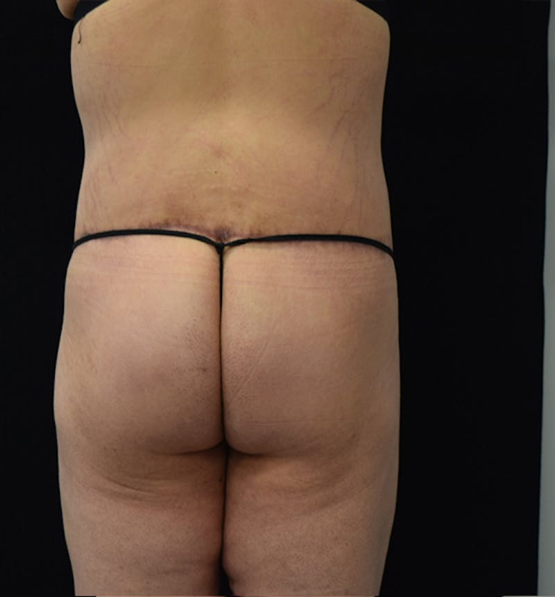 Fat Transfer to Buttock Before & After Gallery - Patient 102566250 - Image 12