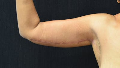 Brachioplasty Before & After Gallery - Patient 102566395 - Image 2