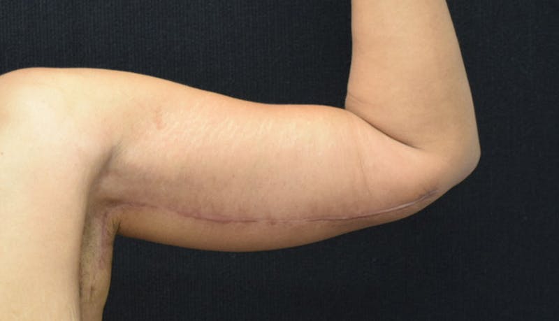 Brachioplasty Before & After Gallery - Patient 102566395 - Image 4