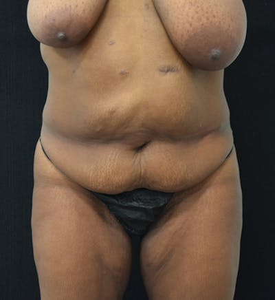 Fat Transfer Gallery - Patient 102566428 - Image 1