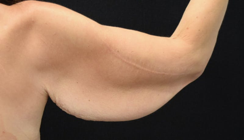Brachioplasty Before & After Gallery - Patient 102566414 - Image 5