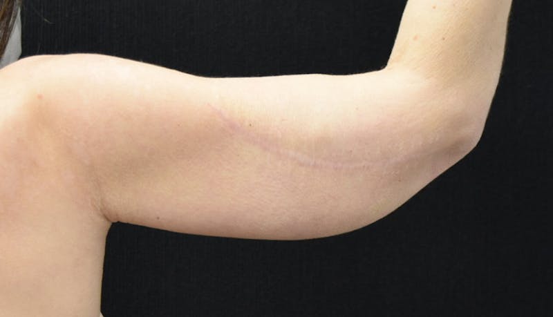 Brachioplasty Before & After Gallery - Patient 102566414 - Image 6