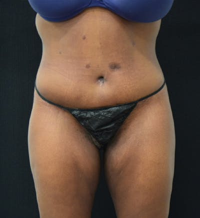 Fat Transfer to Buttock Before & After Gallery - Patient 102566428 - Image 2
