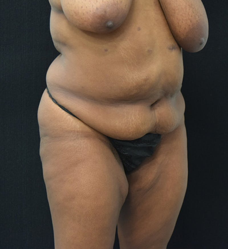 Fat Transfer Gallery - Patient 102566428 - Image 3