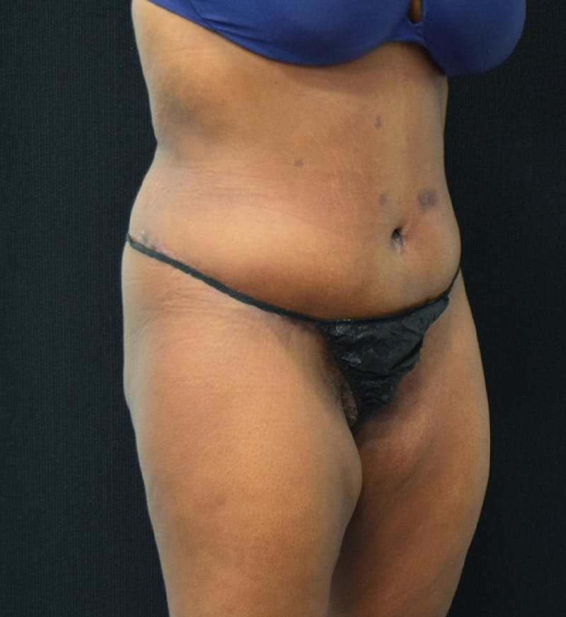 Fat Transfer Gallery - Patient 102566428 - Image 4