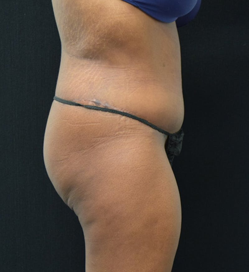 Fat Transfer to Buttock Before & After Gallery - Patient 102566428 - Image 6