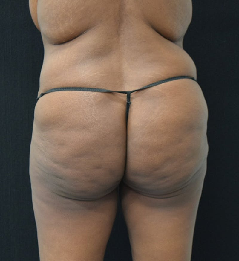 Fat Transfer to Buttock Before & After Gallery - Patient 102566428 - Image 7