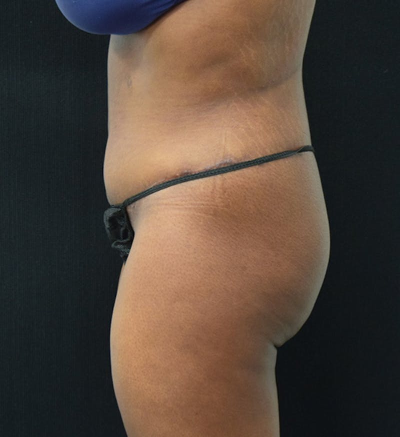 Fat Transfer Before & After Gallery - Patient 102566428 - Image 12