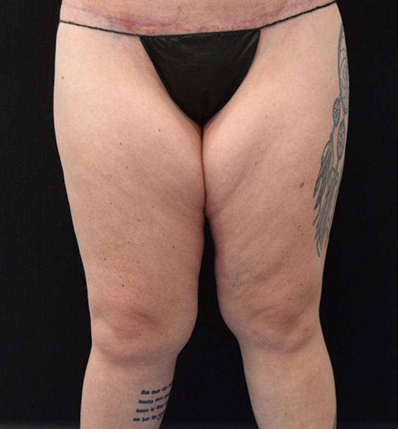 Thigh Lift Before & After Gallery - Patient 102566529 - Image 1