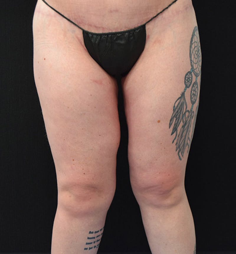 Thigh Lift Before & After Gallery - Patient 102566529 - Image 2