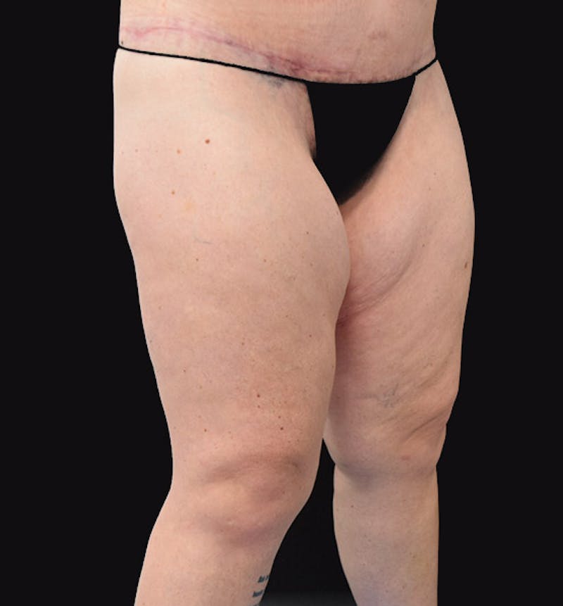 Thigh Lift Before & After Gallery - Patient 102566529 - Image 3