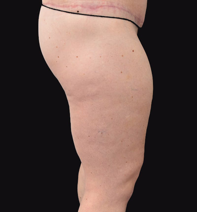 Thigh Lift Before & After Gallery - Patient 102566529 - Image 5
