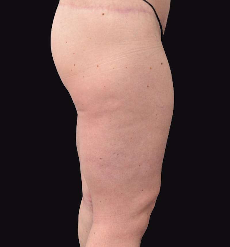 Thigh Lift Before & After Gallery - Patient 102566529 - Image 6