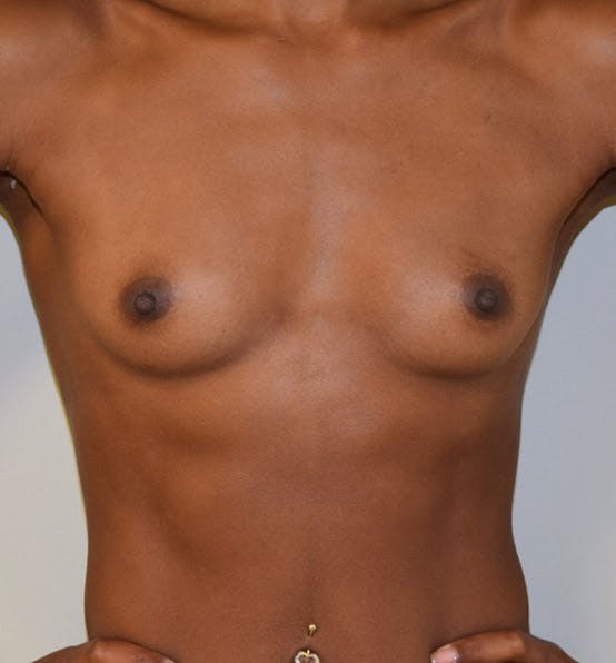 Breast Augmentation